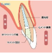ウォーキング・ブリーチ