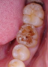 質 再生 エナメル 歯